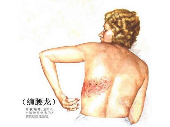 血府逐瘀汤加减治带状疱疹后遗神经痛医案、配方