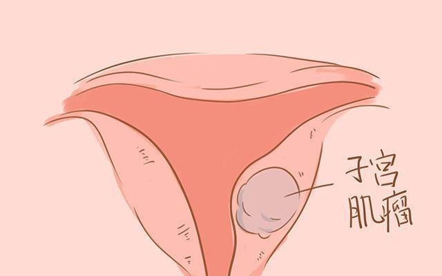 血府逐瘀汤加减治子宫肌瘤医案、配方