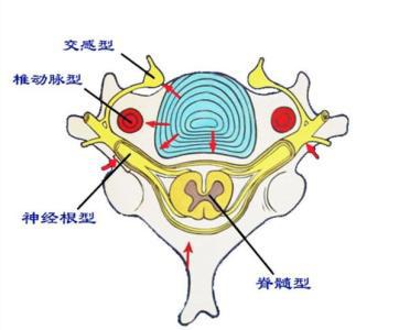 血府逐瘀汤加减治颈椎骨质增生医案、配方