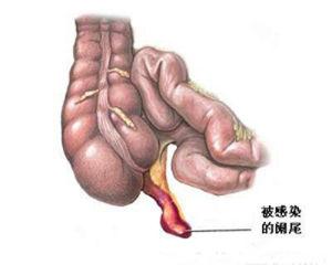 血府逐瘀汤加减治阑尾周围脓肿医案、配方