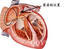 桂枝汤加减治病态窦房结综合征医案、配方