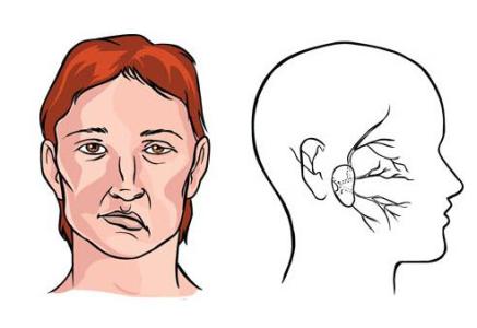 桂枝汤加减治面神经炎医案、配方