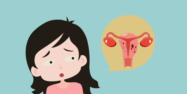 桂枝汤加减治子宫肌瘤医案、配方