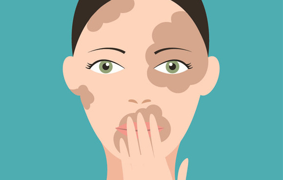 桂枝汤加减治白癜风医案、配方