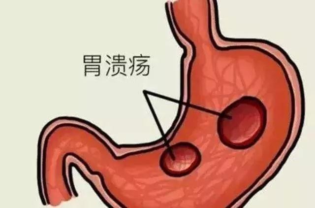 黄连解毒汤加减治十二指肠溃疡医案、配方
