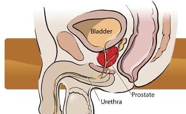 黄连解毒汤加减治急性睾丸炎医案、配方