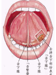 黄连解毒汤加减治舌下腺囊肿医案、配方