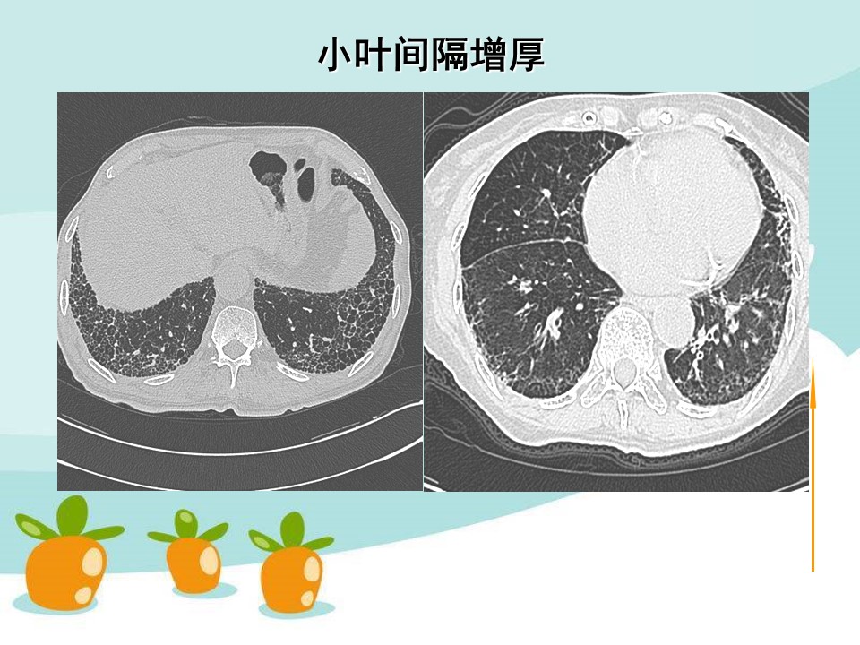 阳和汤加减治肺间质纤维化医案、配方