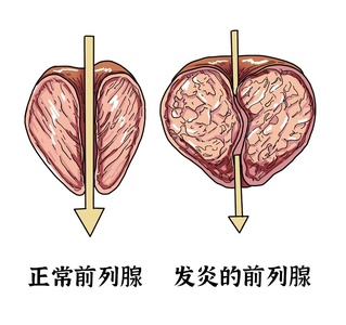 六味地黄丸加减治慢性前列腺炎医案、配方