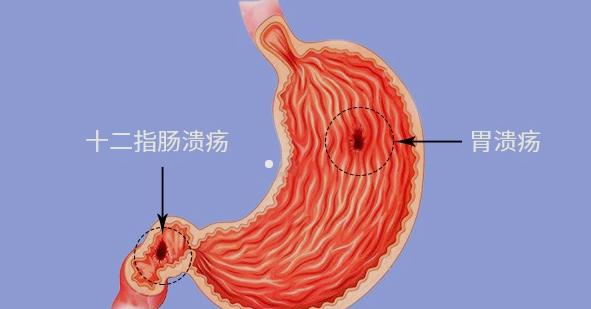 六味地黄丸加减治十二指肠溃疡医案、配方