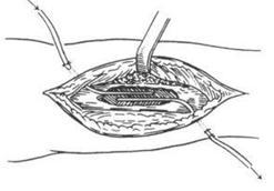 六味地黄丸加减治硬化性骨髓炎医案、配方