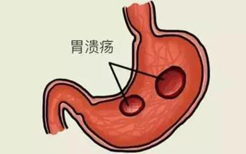 小柴胡汤加减治消化性溃疡医案、配方
