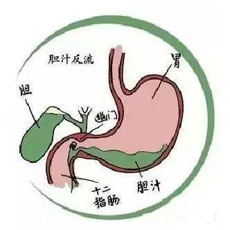 小柴胡汤加减治胆汁反流性胃炎医案、配方