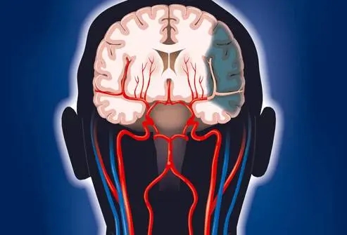 药物性脑卒中是怎么回事