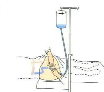 中医对灌肠疗法的研究有什么贡献？