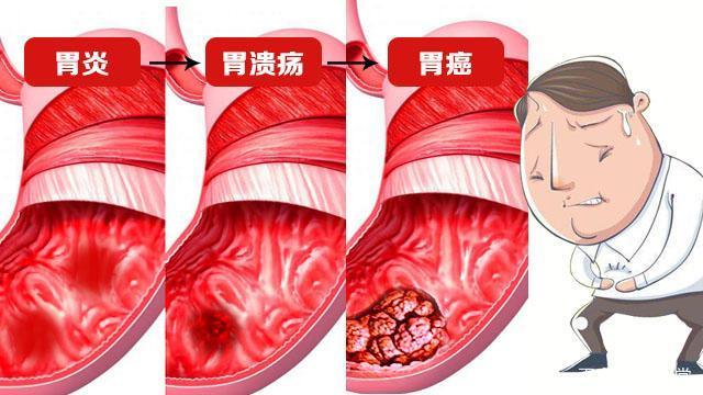 胃溃疡病人常服小苏打好吗?