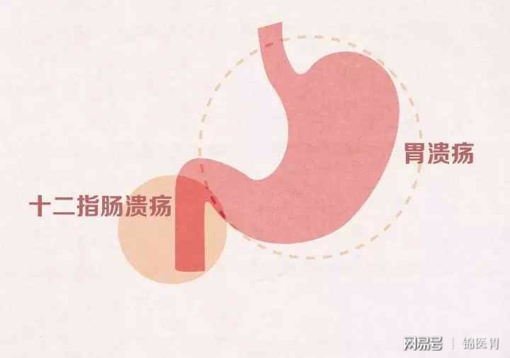 胃与十二指肠溃疡的食疗方有哪些？