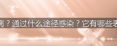 什么叫蛔虫病?通过什么途径感染?它有哪些表现和并发症